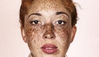 Sommersprossen Freckles Elbank Brock