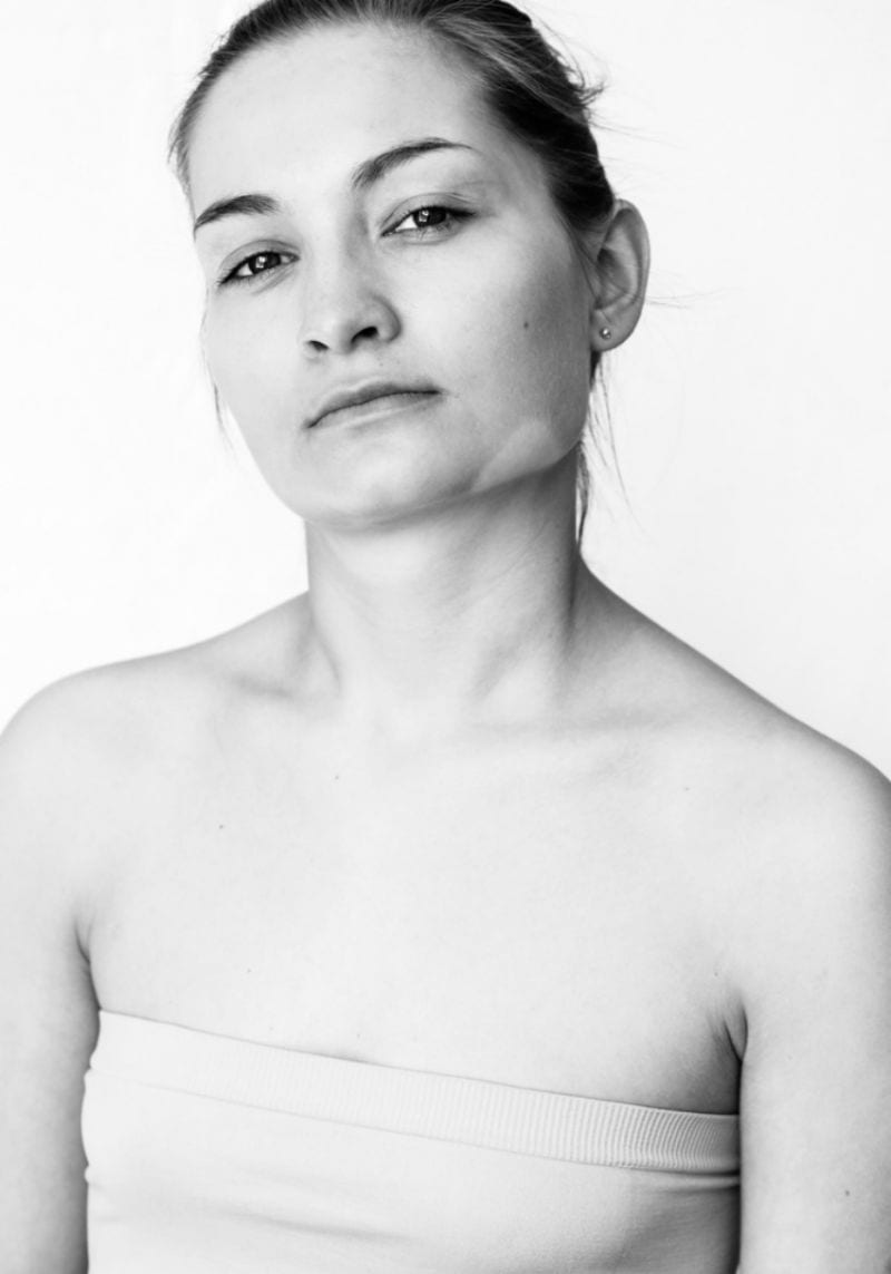 Julia Kaczorowska Beholdthe Beauty of Vitiligo