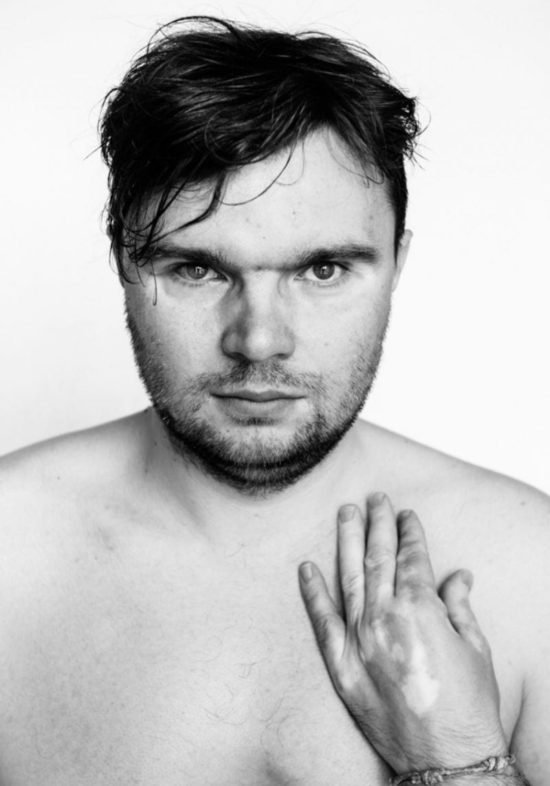 Julia Kaczorowska Behold the Beauty of Vitiligo