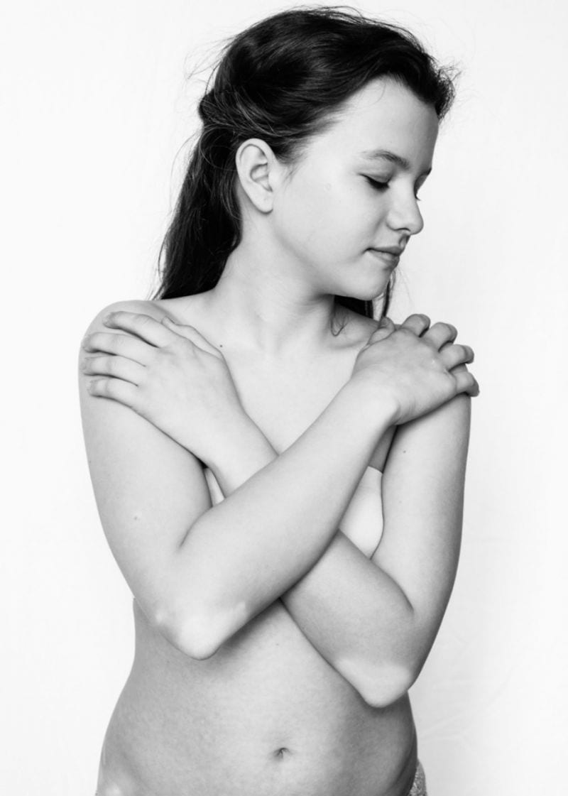 Julia Kaczorowska Behold the Beauty of Vitiligo