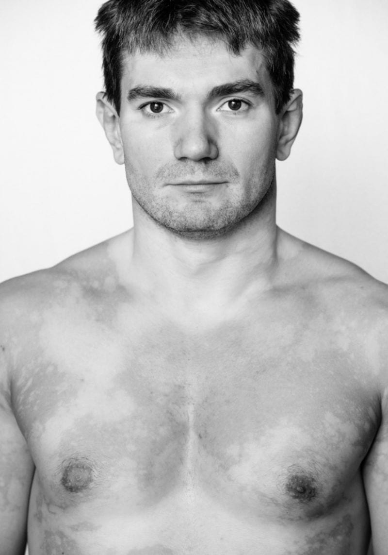 Julia Kaczorowska Behold the Beauty of Vitiligo