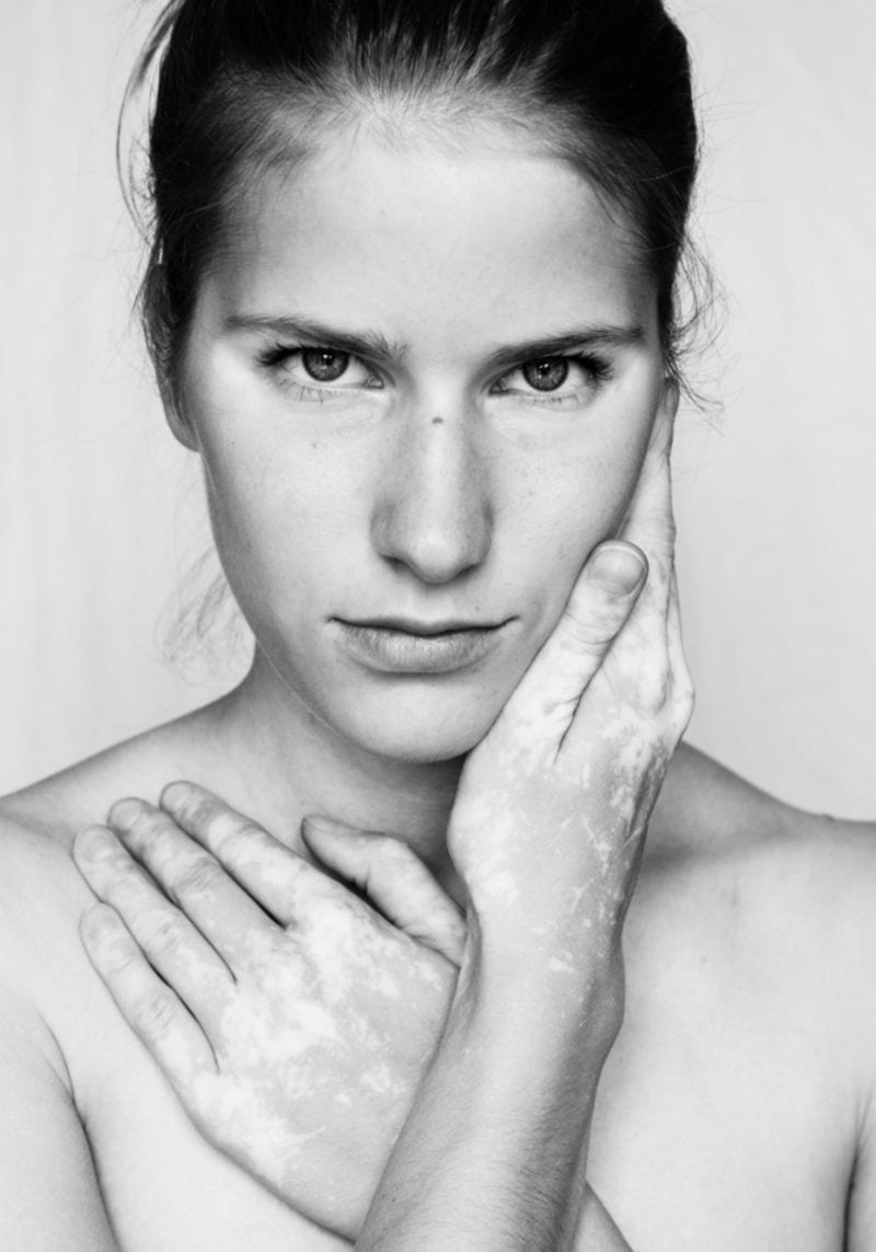 Julia Kaczorowska Behold the Beauty of Vitiligo