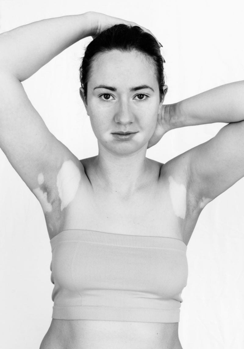 Julia Kaczorowska Behold the Beauty of Vitiligo
