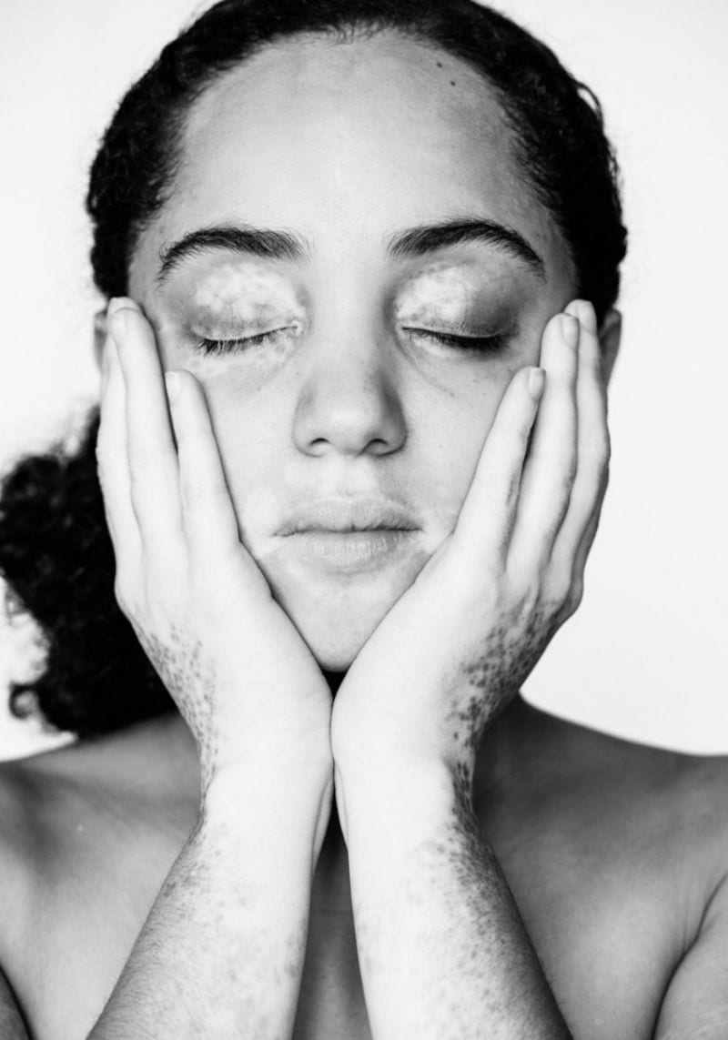 Julia Kaczorowska Beholdthe Beauty of Vitiligo